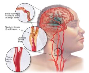 What is CVA: Causes, Symptoms, and Treatment 2024